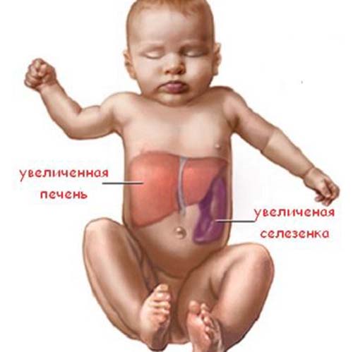 Спленомегалия: причины, симптомы, лечение